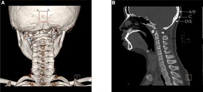 Comparison of structural occipital and iliac bone grafts for instrumented atlantoaxial fusions in pediatric patients: Radiologic research and clinical outcomes